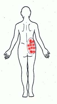 慢性腰痛図２